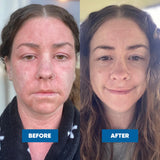 Pink Cream for Chronic Eczema with Frequent Flare-Ups