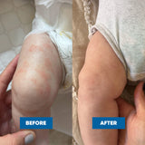 Pink Cream for Chronic Eczema with Frequent Flare-Ups